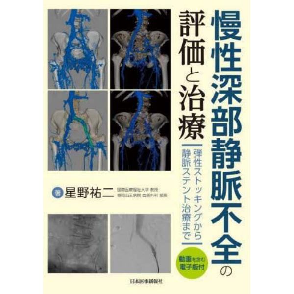 慢性深部静脈不全の評価と治療　弾性ストッキングから静脈ステント治療まで