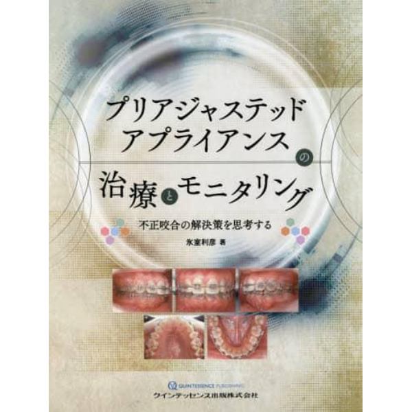 プリアジャステッドアプライアンスの治療とモニタリング　不正咬合の解決策を思考する