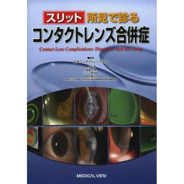 スリット所見で診るコンタクトレンズ合併症