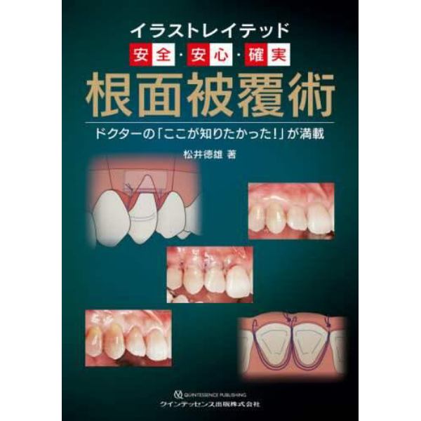 イラストレイテッド安全・安心・確実　根面被覆術　ドクターの「ここが知りたかった！」が満載