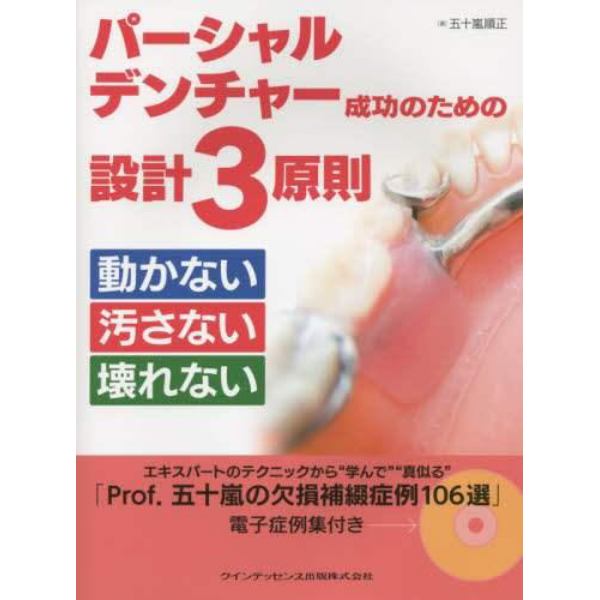 パーシャルデンチャー成功のための設計３原則　動かない汚さない壊れない