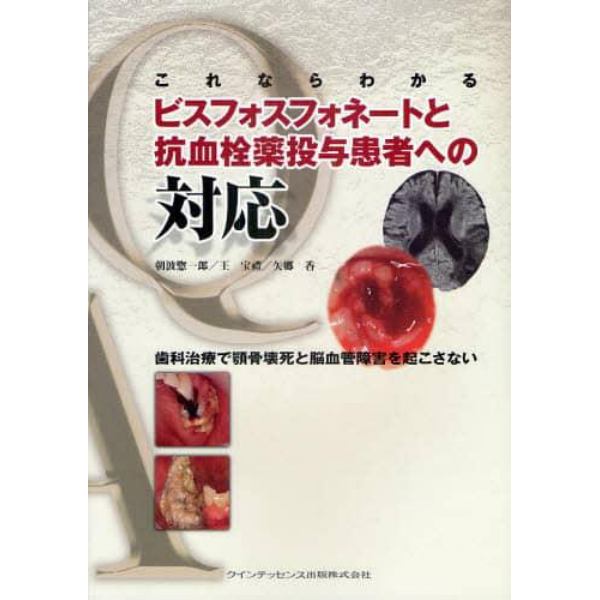 これならわかるビスフォスフォネートと抗血栓薬投与患者への対応　歯科治療で顎骨壊死と脳血管障害を起こさない