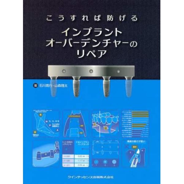 こうすれば防げるインプラントオーバーデンチャーのリペア