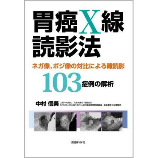 胃癌Ｘ線読影法　ネガ像，ポジ像の対比による難読影１０３症例の解析