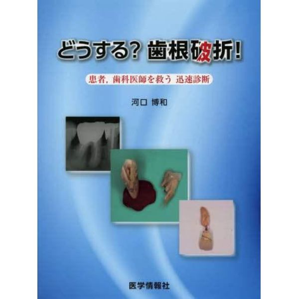 どうする？歯根破折！　患者，歯科医師を救う迅速診断