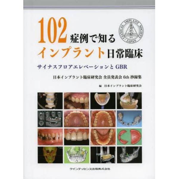 １０２症例で知るインプラント日常臨床　サイナスフロアエレベーションとＧＢＲ　日本インプラント臨床研究会全員発表会６ｔｈ抄録集