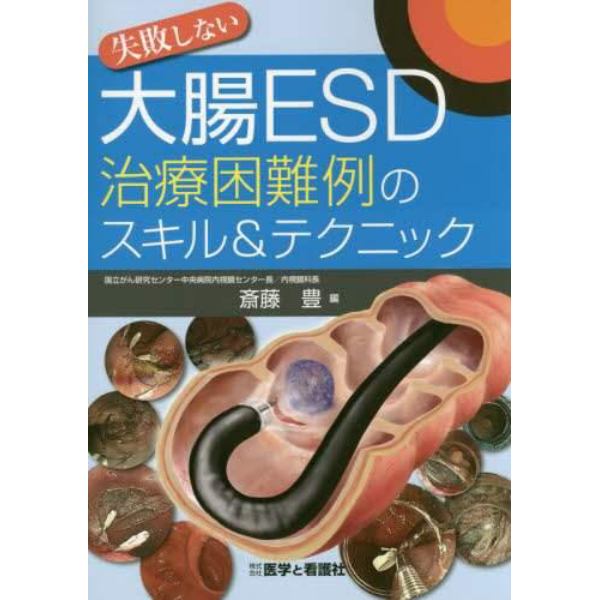 失敗しない大腸ＥＳＤ治療困難例のスキル＆テクニック