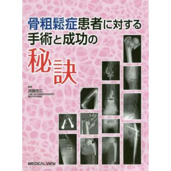 骨粗鬆症患者に対する手術と成功の秘訣