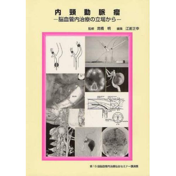 内頸動脈瘤　脳血管内治療の立場から　第１５回脳血管内治療仙台セミナー講演集
